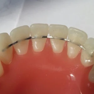 Direct bonding retainer V-loop (includes transfer key)
