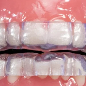 Full occlusal splint with NTI